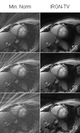 cardiac_radial_irgntv