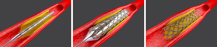 Grafik eines Blutgefäßes, in das ein Stent eingeführt wird.