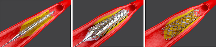© magraphics - Fotolia.com Grafik eines Blutgefäßes, in das ein Stent eingeführt wird.