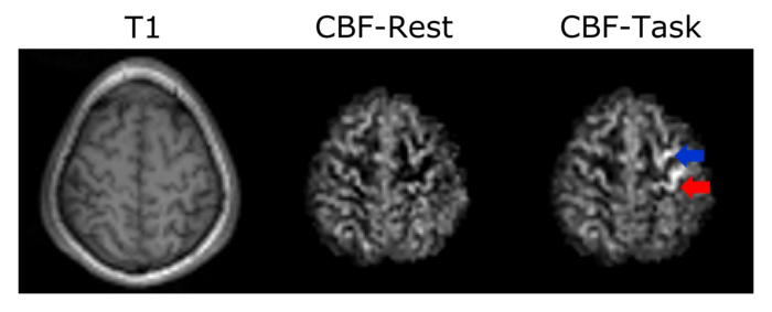 Three pictures of a brain. The first one is labelled T1 and shows the brain with a small glow around it. The second one is labelled CBF-Rest and just shows the brain. The third one is labelled CBF-Task and a red arrow points at a light region in the brain while a blue arrow points at a dark region.