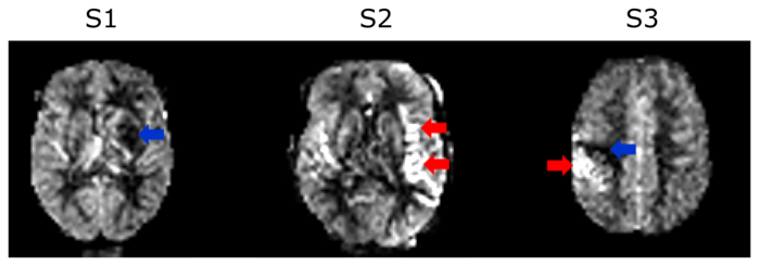 There are three pictures of a brain. Above the first one it says S1, above the second S2 and above the third S3. There is a blue arrow pointing at a dark part the middle of the brain in S1. There are two red arrows pointing at a very light part on the left side of the brain in S2. There is a blue arrow pointing at a dark part on the left side of S3 and a red arrow pointing at a light part also on the left side of S3.