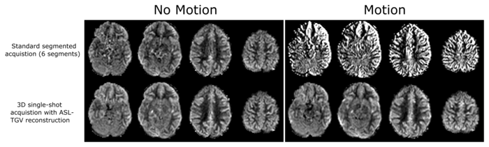 There are two pictures with two rows of four pictures of a brain each. The first one is titelt No Motion and the second one Motion. The second one is sharper, than the first one. Next to the first row it says Standard segmented acquisition (6 segments). Next to the second row it says 3D single-shot acquisition with ASL-TGV reconstruction.