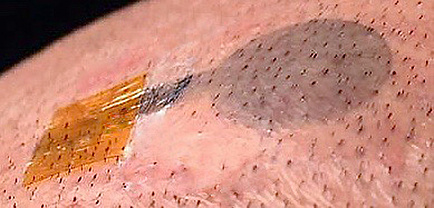 Nahaufnahme einer Tattoo-Elektrode auf Haut