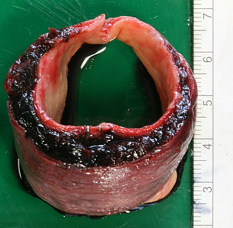 Bloodshot aorta piece on green base