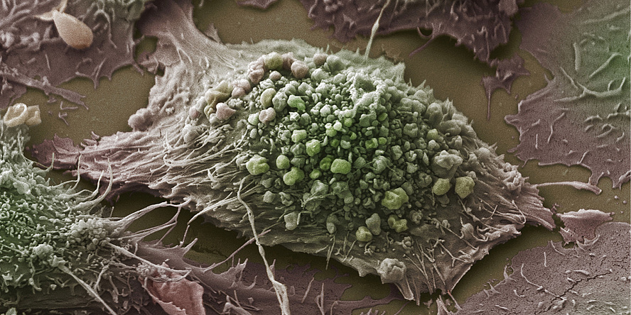 An image of a lung cancer cell as seen under a scanning electron microscope.