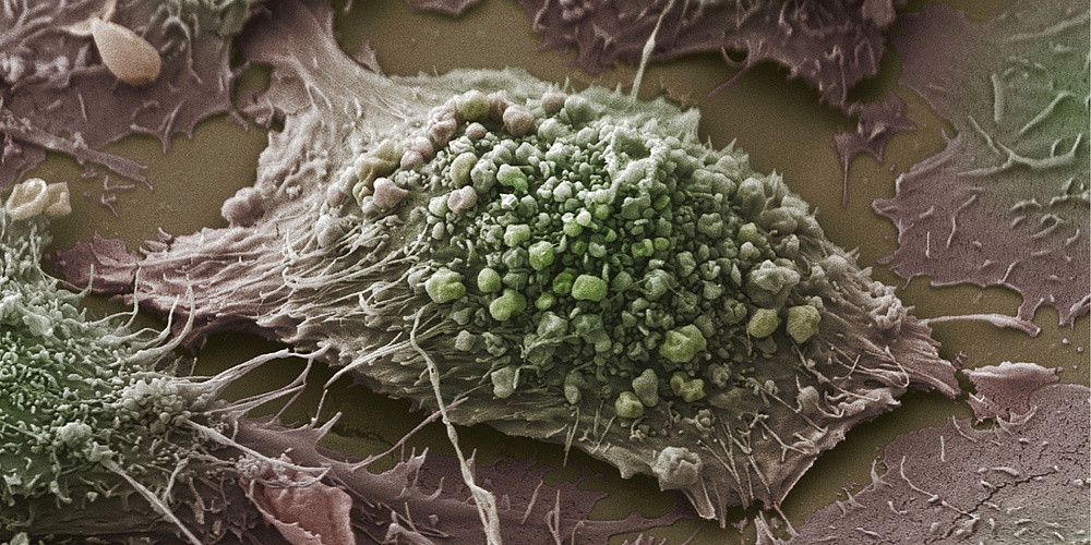 An image of a lung cancer cell as seen under a scanning electron microscope.