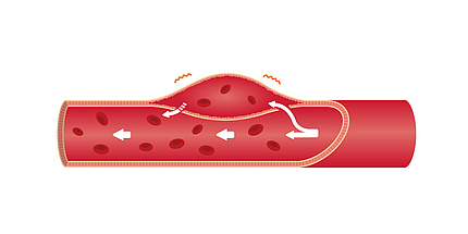 Graphic representation of an aortic dissection